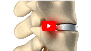 Vital Center Kroker Video zur Indikation Nervendurchtrennung nach einer Verletzung