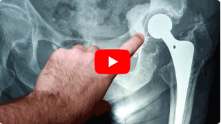 Vital Center Kroker Video zur Indikation Operationen des Hüftgelenks