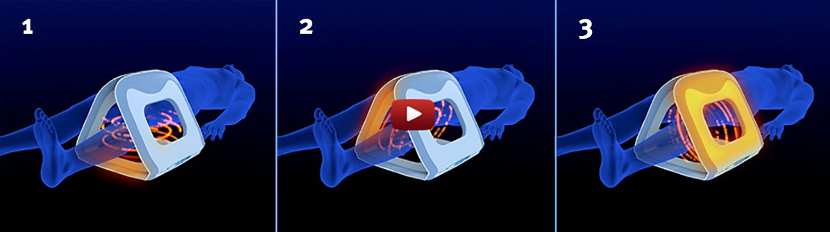 Video für die Verwendung eines Applikators am Knie